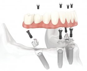 Replace your Denture with Dental Implants - rockinghamhousedentist