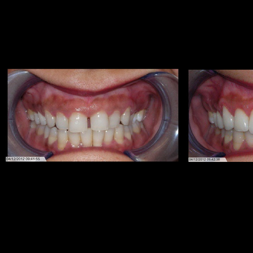 Smile Makeovers